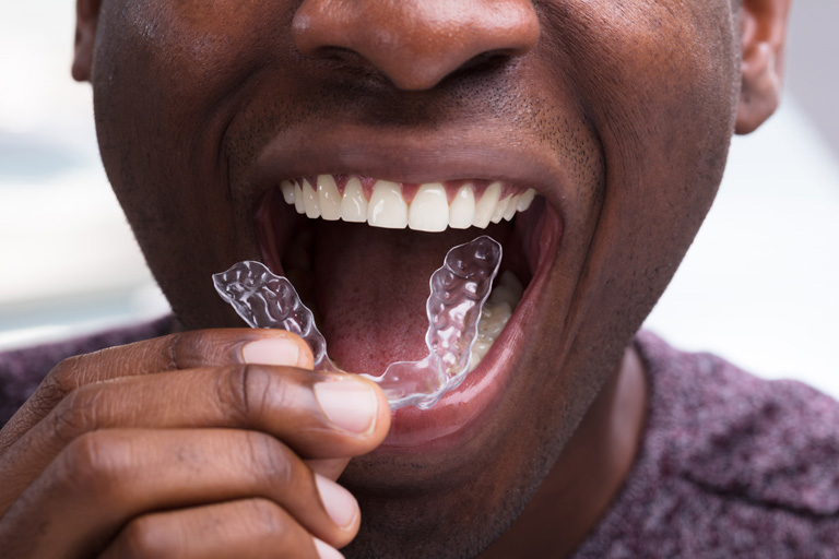 Affordable invisalign treatment in Cardiff at Bay House Dental Practice
