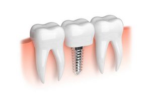 Affordable Dental Implants at Bay House Dental Practice, Cardiff