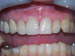 single crown replacement and white filling at Bay House Dental Practice (after image)