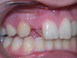 single crown replacement and white filling at Bay House Dental Practice (before image)