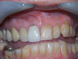 single crown replacement and white filling at Bay House Dental Practice (before image)