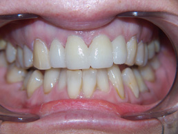 veneers treatment in cardiff at Bay House Dental Practice (after Image_2)