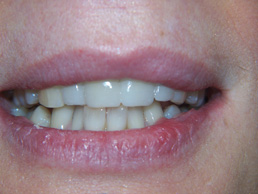 veneers treatment in cardiff at Bay House Dental Practice (after Image)