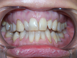 veneers treatment in cardiff at Bay House Dental Practice (before Image_1)