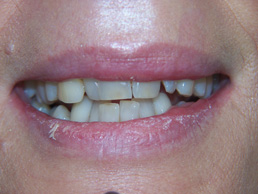 veneers treatment in cardiff at Bay House Dental Practice (before Image)