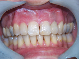 white filling & new crowns treatment in cardiff at Bay House Dental Practice (after Image)