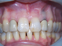 white filling & new crowns treatment in cardiff at Bay House Dental Practice (before Image)