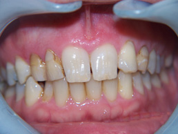 white filling & veneers treatment in cardiff at Bay House Dental Practice (before Image_1)