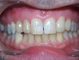 white filling & veneers treatment in cardiff at Bay House Dental Practice (after Image_1)