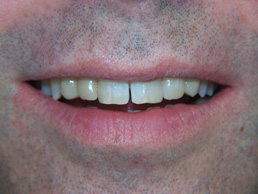 white filling & veneers treatment in cardiff at Bay House Dental Practice (after Image)