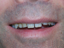 white filling & veneers treatment in cardiff at Bay House Dental Practice (Before Image)